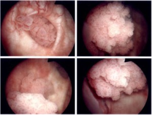 膀胱鏡でみる膀胱がんの様子