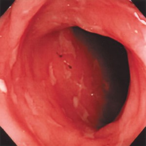 内視鏡でみる大腸の画像です