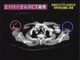 ビバリーさんの胸部CT