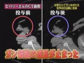 投与前後のCT